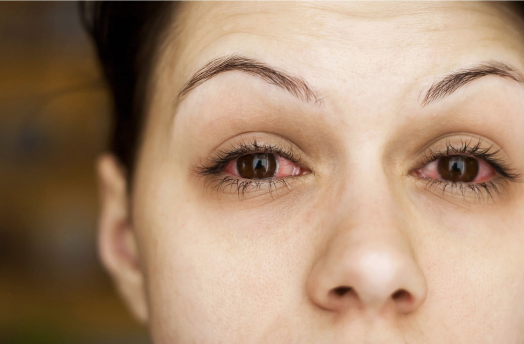 Woman with red, irritated eyes due to meibomian gland dysfunction