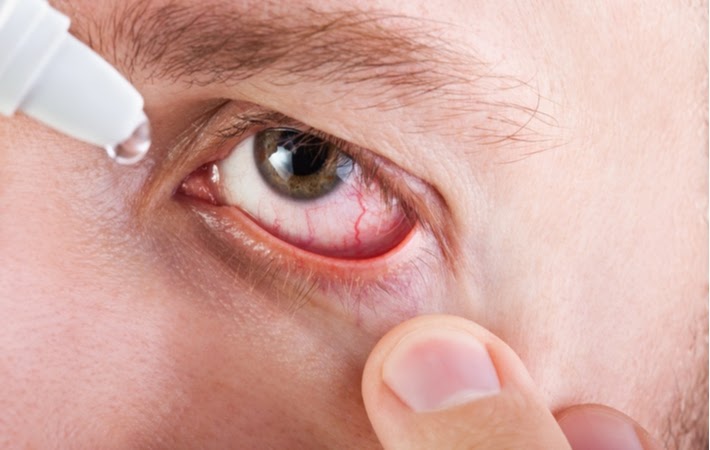 Close up of a man putting eye drops into his red, irritated eye from dry eye syndrome