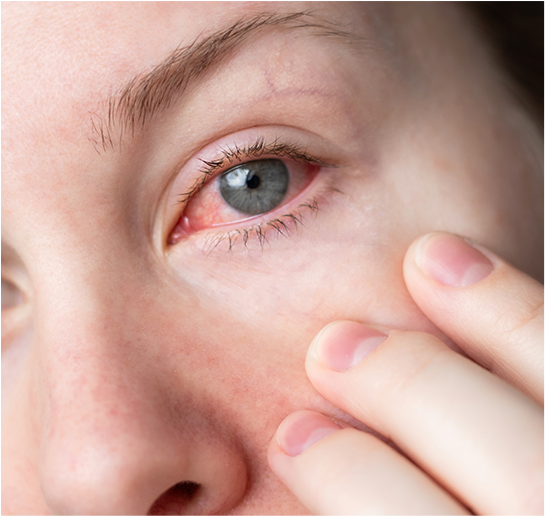 womans-eyes-feels-dry-but-still-water